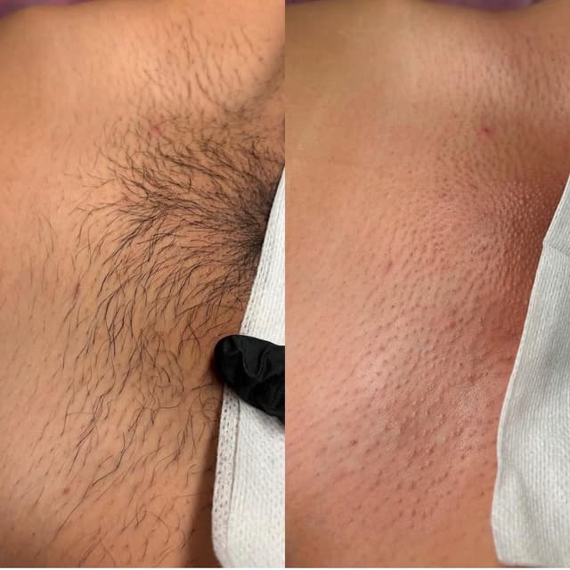 Touch of Silk Brazilian Bundle at Lins Esthetics in Gaithersburg, MD